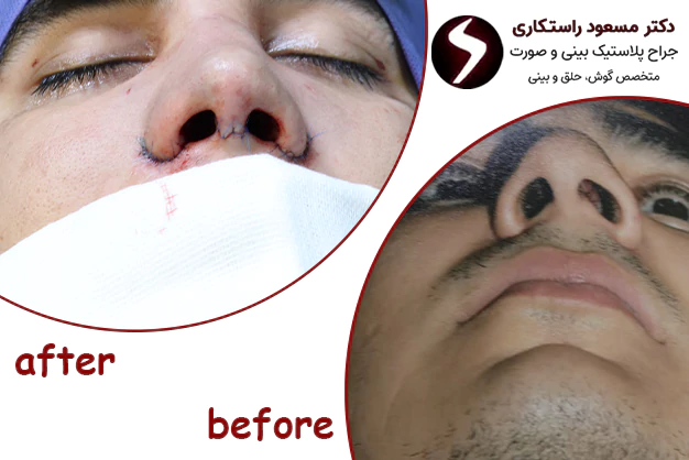 نمونه کار جراحی انحراف بینی نمونه کار جراحی انحراف بینی