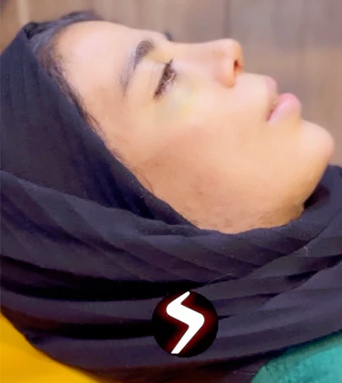 نتیجه جراحی بینی طبیعی نتیجه جراحی بینی طبیعی
