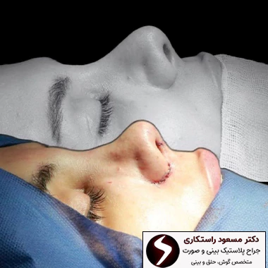 نمونه کار بهترین جراح بینی در تهران