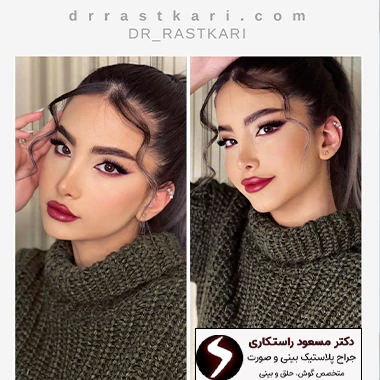 نمونه کار جراحی بینی دکتر مسعود راستکاری