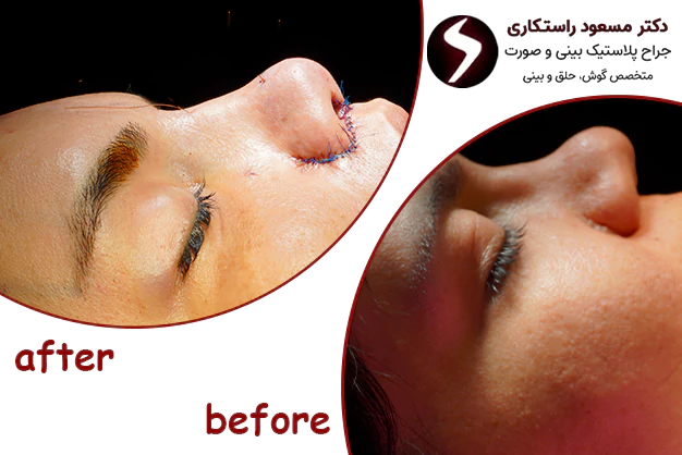 نمونه کار دکتر راستکاری بهترین جراح بینی در تهران
