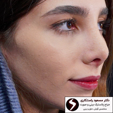 بعد از جراحی بینی