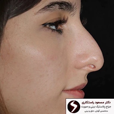 قبل جراحی زیبایی بینی