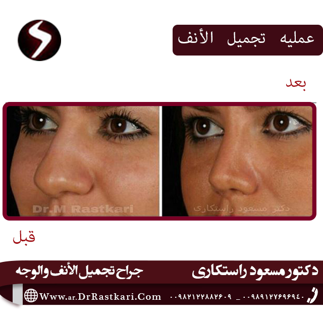 کیف تختار جراح الانف الثانویه