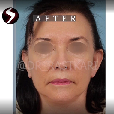 عکس بعد عمل توسط بهترین جراح لیفت صورت