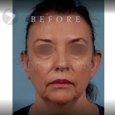 عکس قبل عمل توسط بهترین جراح لیفت صورت