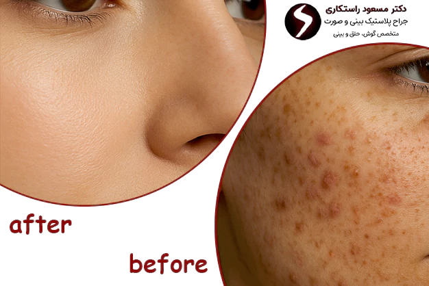 عکس قبل و بعد لیزر فرکشنال