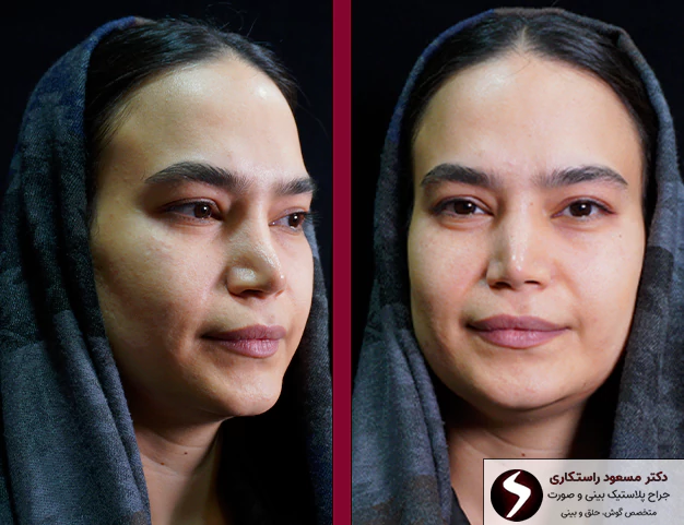 عکس نمونه کار بعد از جراحی بینی گوشتی عکس نمونه کار بعد از جراحی بینی گوشتی
