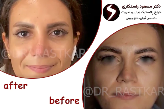 قبل و بعد جراحی زیبایی پلک قبل و بعد جراحی زیبایی پلک