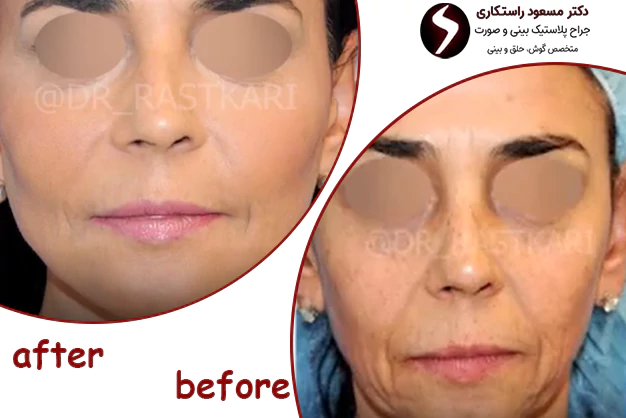 نمونه کار بهترین جراح لیفت صورت
