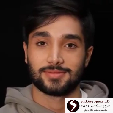 بعد از عمل بینی مردانه