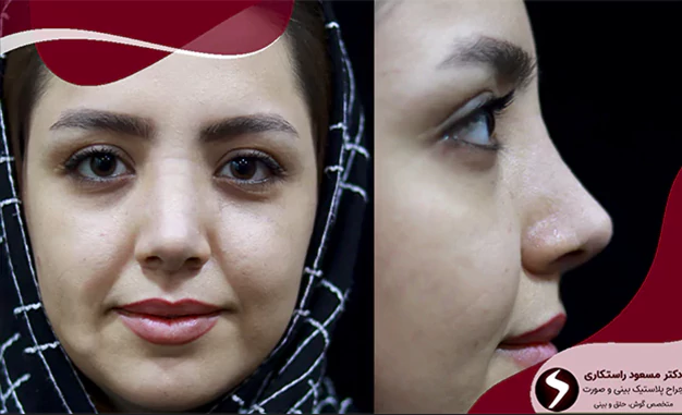 جراحی بینی نیمه فانتزی نوک گرد جراحی بینی نیمه فانتزی نوک گرد