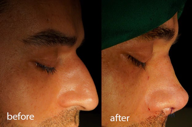 جراحی قوز بینی جراحی قوز بینی