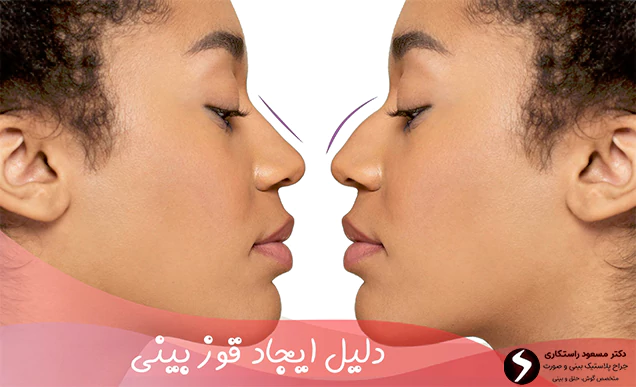 دلیل ایجاد قوز بینی دلیل ایجاد قوز بینی