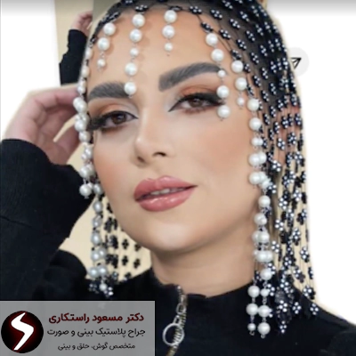 رضایت از جراحی بینی نیمه فانتزی دکتر راستکاری رضایت از جراحی بینی نیمه فانتزی دکتر راستکاری