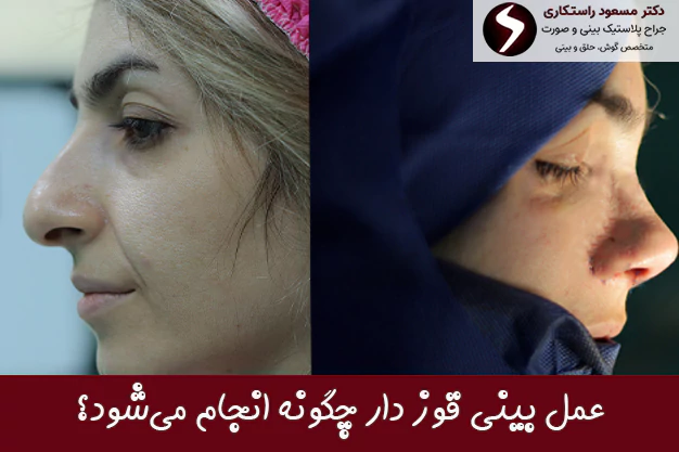 عمل بینی قوز دار چگونه انجام می‌شود؟