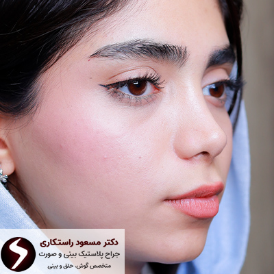 عکس بعد از جراحی بینی کج