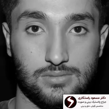 قبل عمل بینی مردانه