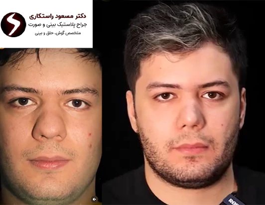 قبل و بعد جراحی بینی مردانه