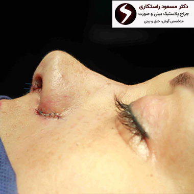 مراقبت های لازم بعد از عمل بینی کج