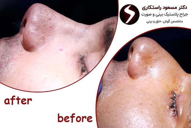 مزایای جراحی بینی مردانه