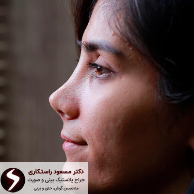 نتیجه عمل بینی کج