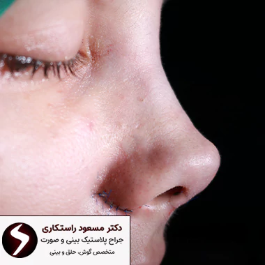 تکنیک جراحی شکستگی بینی