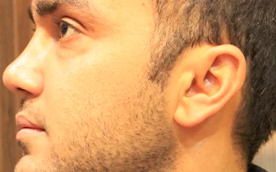 عمل بینی در ترکیه؛ راهنمای کامل مراحل عمل از صفر تا صد + فیلم