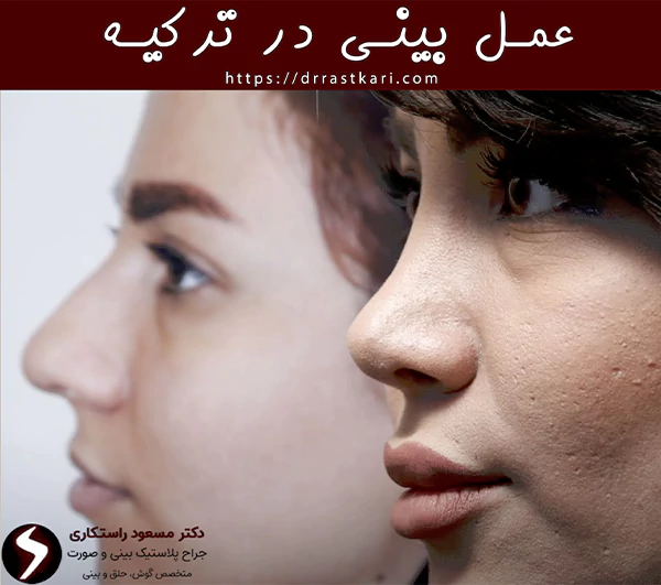 عمل بینی در ترکیه عمل بینی در ترکیه