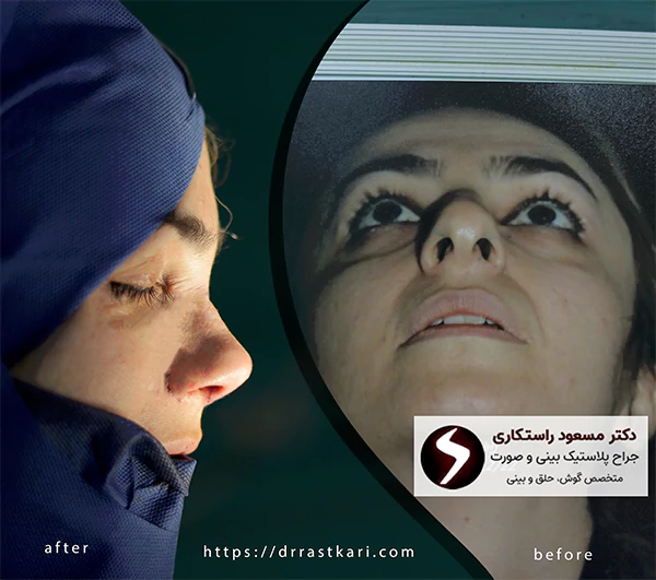 مزایای جراحی بینی پهن مزایای جراحی بینی پهن