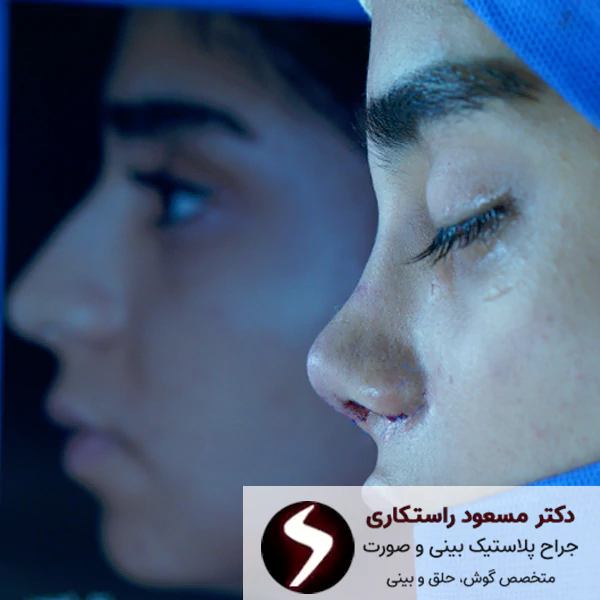 چرا عمل بینی در ترکیه؟ چرا عمل بینی در ترکیه؟