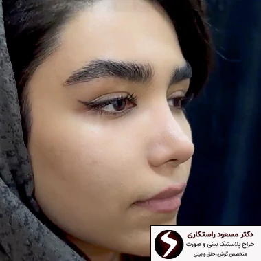 جراحی بینی گوشتی برگشت پذیر است؟