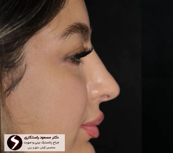 عکس قبل عمل جراحی بینی دکتر راستکاری