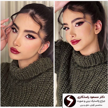 کاهش احتمال برگشت بینی گوشتی