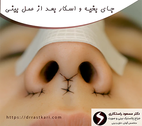 جای بخیه و اسکار بعد از جراحی بینی