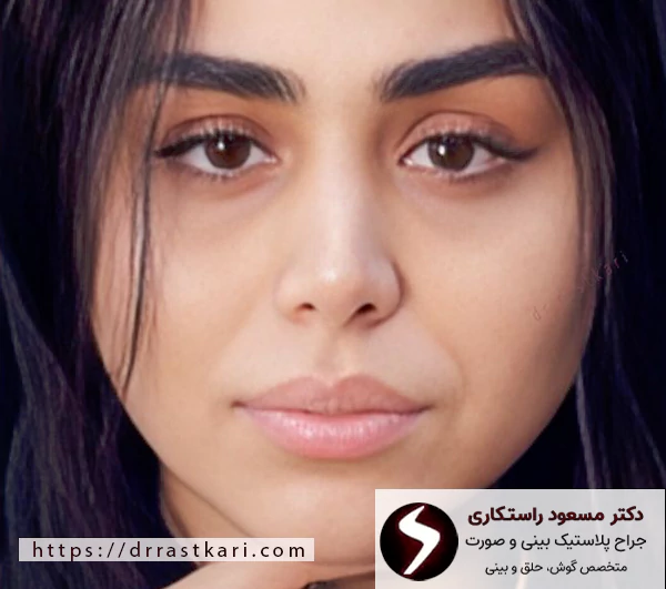 نتیجه عمل بینی دکتر راستکاری