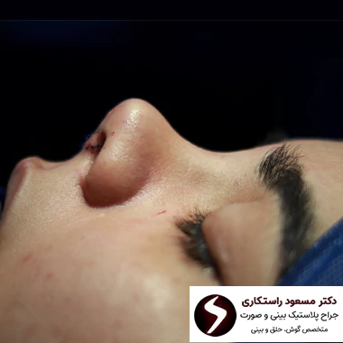 بعد از جراحی بینی گوشتی