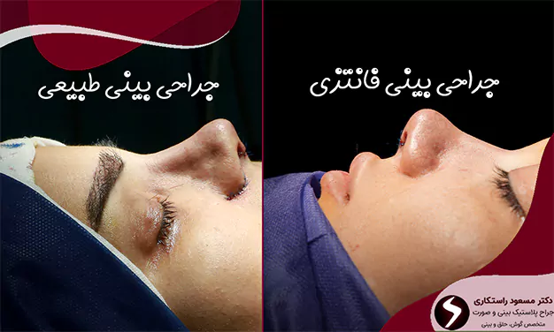 تفاوت جراحی بینی طبیعی فانتزی
