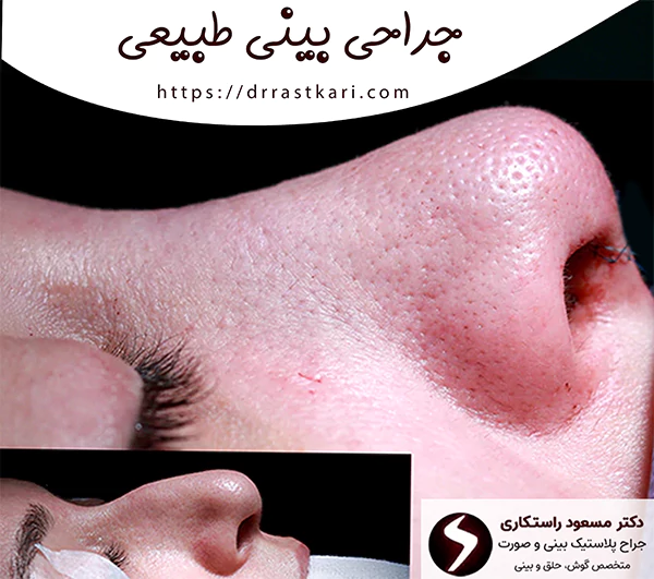 جراحی بینی طبیعی جراحی بینی طبیعی