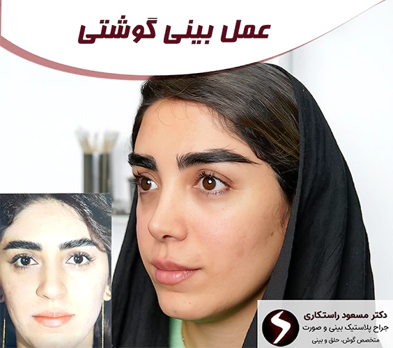 عمل بینی گوشتی عمل بینی گوشتی