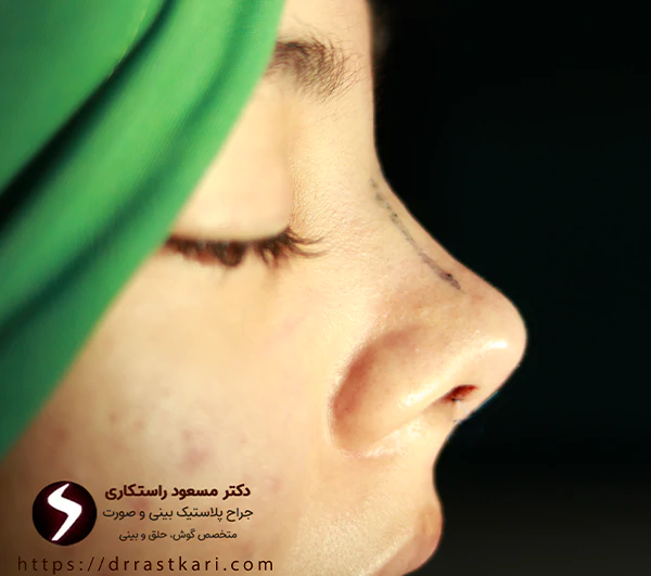 عکس بعد از جراحی بینی فانتزی