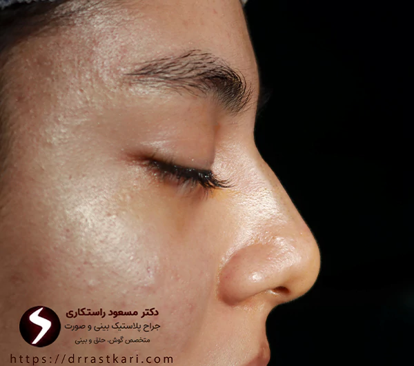 عکس قبل جراحی بینی فانتزی