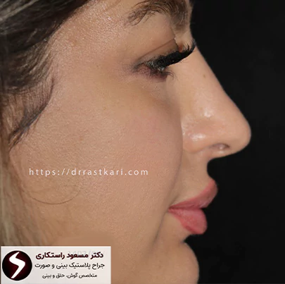 عکس قبل عمل بینی