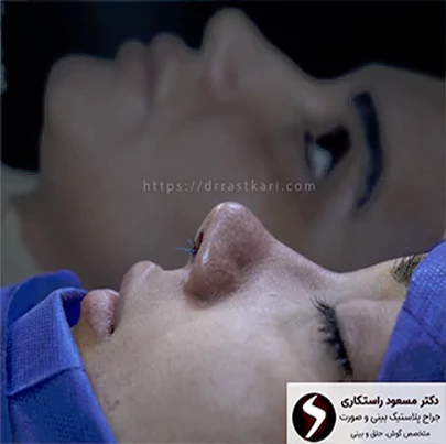 عکس نمونه کار دکتر راستکاری بهترین جراح بینی پاسداران