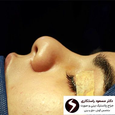 قبل از جراحی بینی گوشتی قبل از جراحی بینی گوشتی
