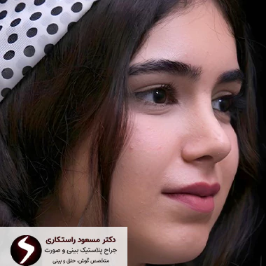 نتیجه جراحی بینی گوشتی نتیجه جراحی بینی گوشتی