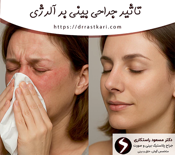 تاثیر جراحی بینی بر آلرژی تاثیر جراحی بینی بر آلرژی