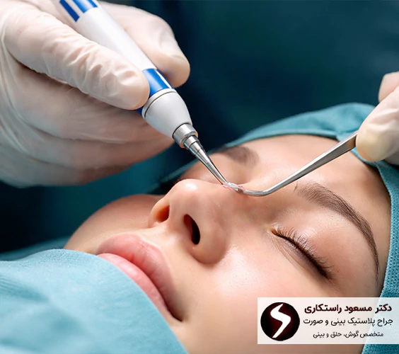 مراقبت های بعد از جراحی پیزوسرجری بینی