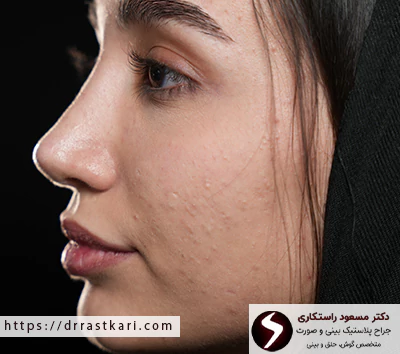 نمونه کار جراحی بینی ترمیمی دکتر راستکاری نمونه کار جراحی بینی ترمیمی دکتر راستکاری