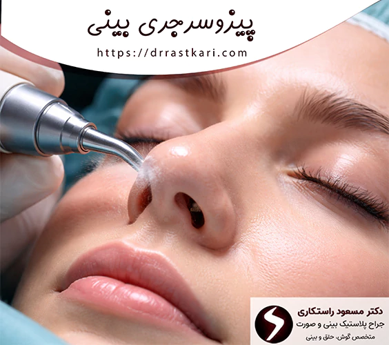 پیزوسرجری بینی